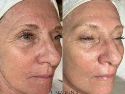 Facials - Anti-aging Facials - Anti-aging