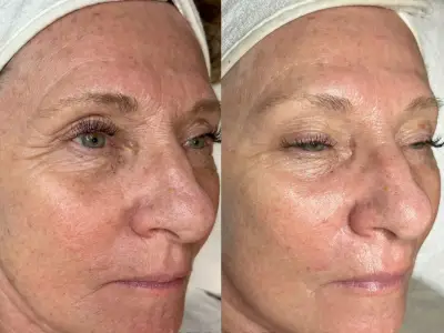 Facials - Anti-aging